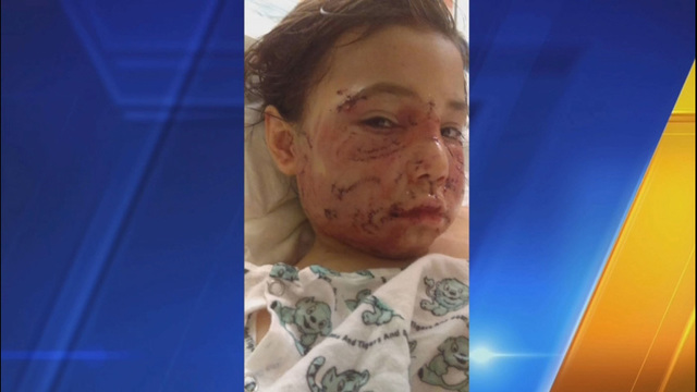 7살 소년 3마리 개에 공격받아