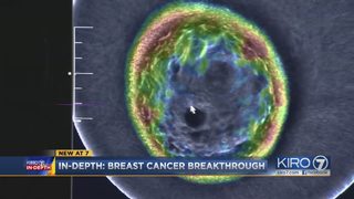 VIDEO: A breast cancer breakthrough in Seattle
