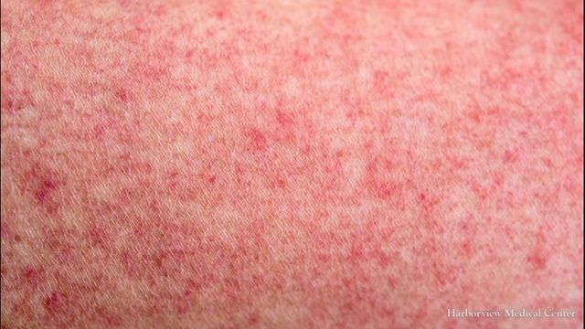 Each Case Of Measles Costs 33000 There >> New Bill Would Remove Personal Objection From Measles Vaccine Kiro Tv Each Case Of Measles Costs 33000 There >> New Bill Would Remove Personal Objection From Measles Vaccine Kiro Tv